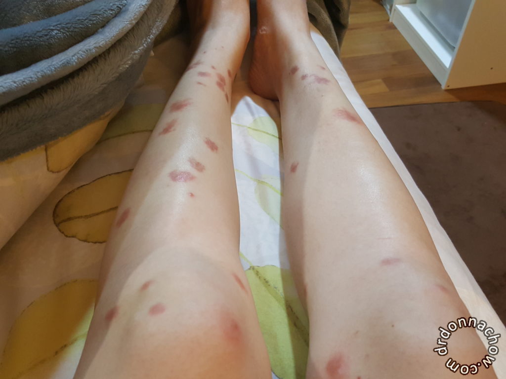 This was how my legs look like after the trip